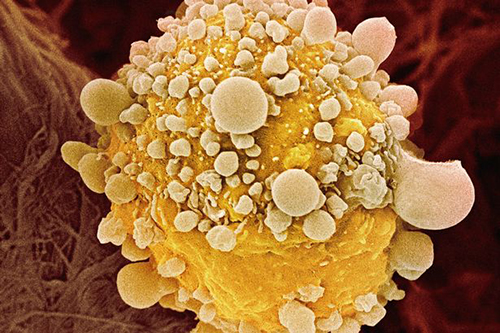 pancreatic-cancer-cell.jpg