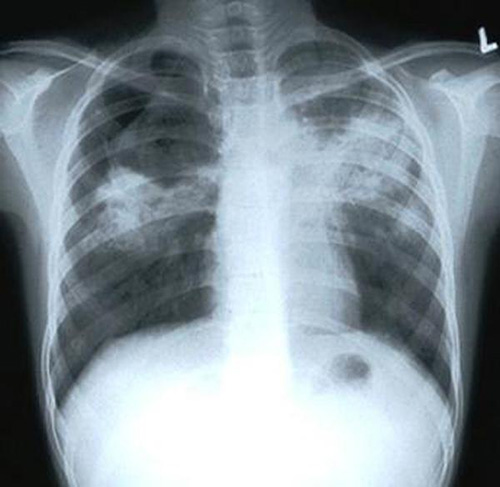tuberkulez-3.jpg